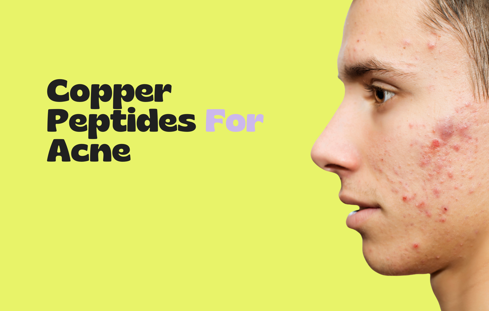 HapiPatch.com Copper Peptides for Acne HapiPatch.com Copper Peptides for Acne