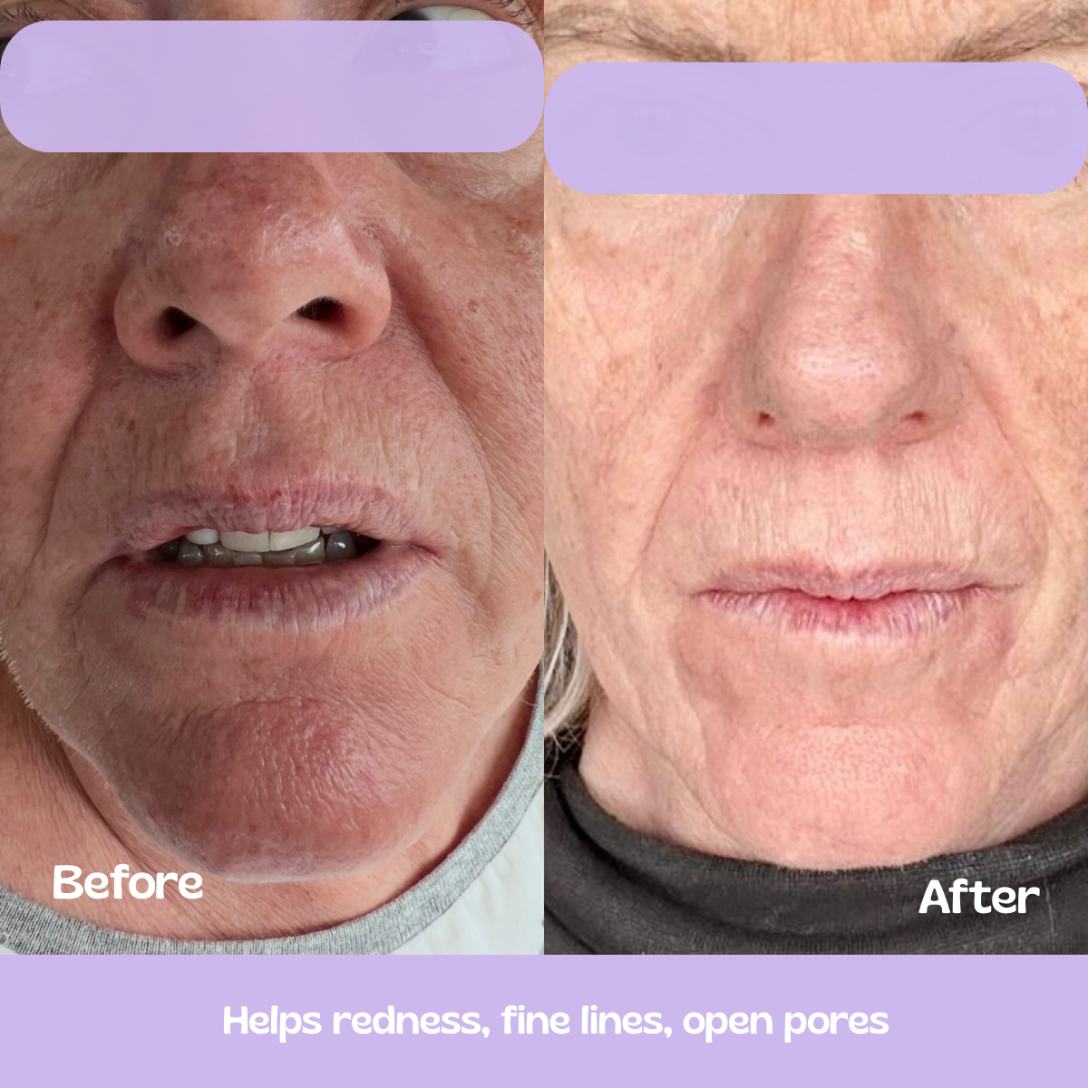 Glow Up GHK-Cu Copper Peptide Patches