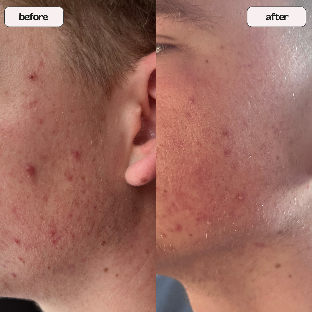 Collagen patches for scars 2025